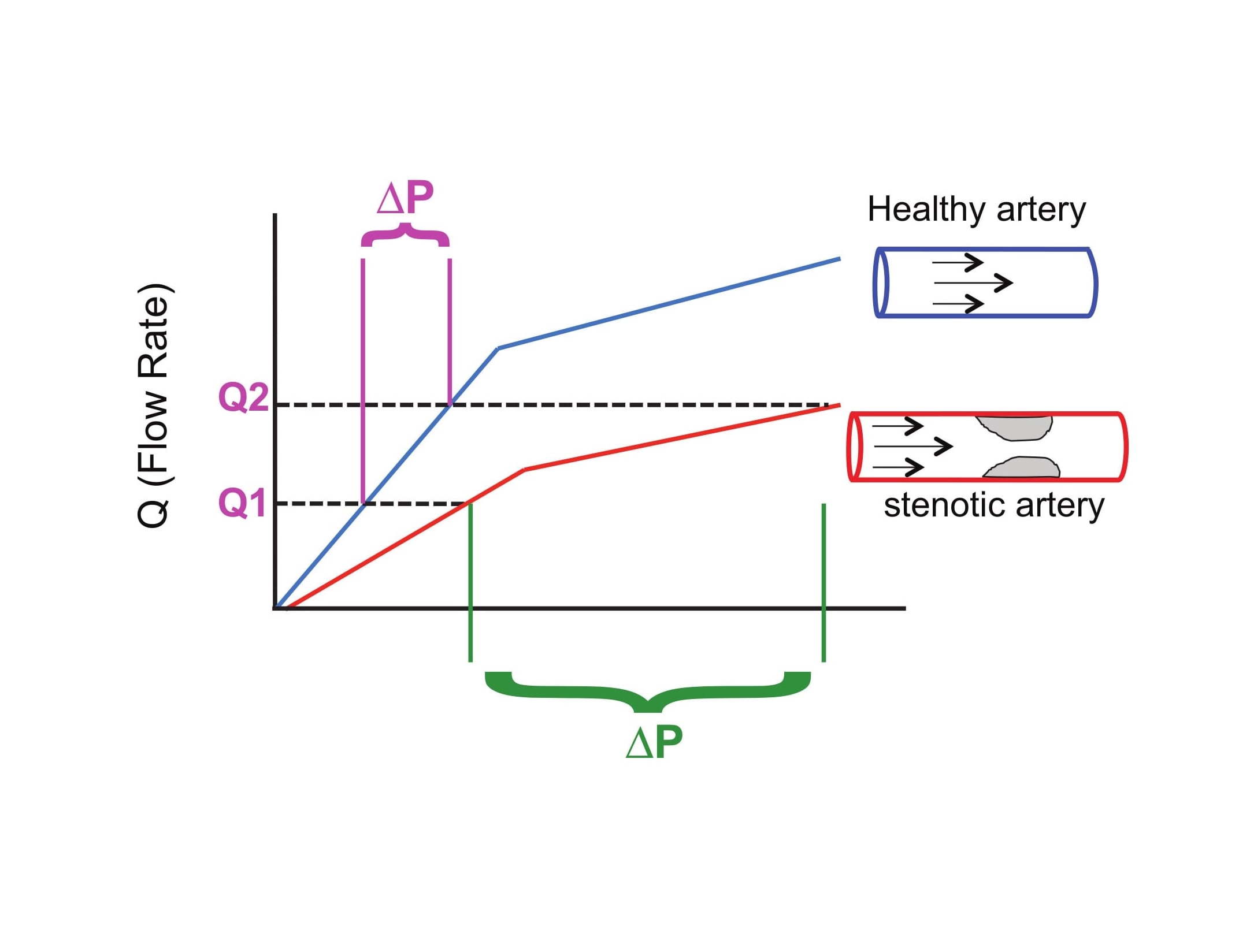 Stenotic artery pressure flow